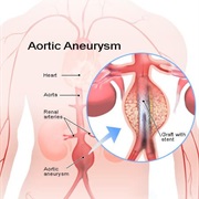 Abdominal Aortic Aneurysm (AAA)