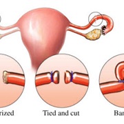 Tubal Ligation/Vasectomy Instead of Hormonal Contraceptives