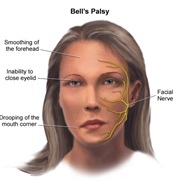 Bell&#39;s Palsy