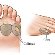 Calluses