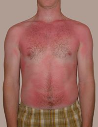 Sunburn