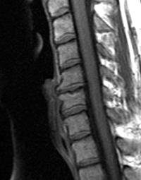 Degenerative Disc Disease