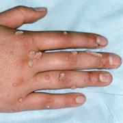 Warts