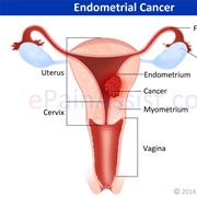 Uterine Cancer