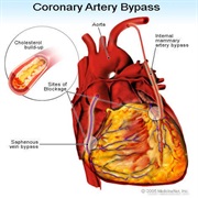 Coronary Artery Bypass Surgery