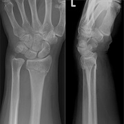 Broken a Wrist