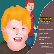 Angelman Syndrome