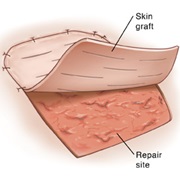 Skin Graft