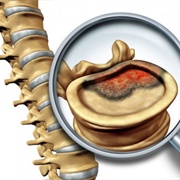 Spinal Cancer