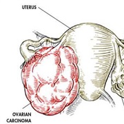 Ovarian Cancer