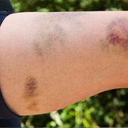 Bruises