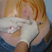 Lumbar Puncture