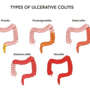Ulcerative Colitis (UC)