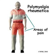 Polymyalgia Rheumatica