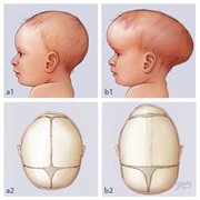 Craniosynostosis Awareness Month (October)