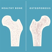 World Osteoporosis Day (October 20)