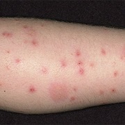 Gotten Over 100 Bug Bites