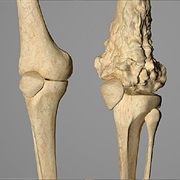 Osteosarcoma
