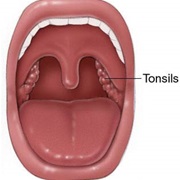 Tonsils Removed