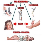 Eclampsia