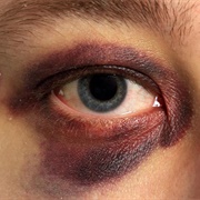 Black Eye