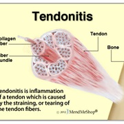 Tendonitis