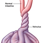 Intestinal Malrotation and Volvulus Awareness Day (January 15)