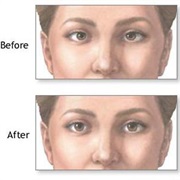 Lazy Eye (Amblyopia)