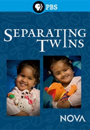 NOVA: Separating Twins (2012)