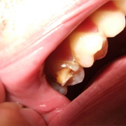 Broken Tooth