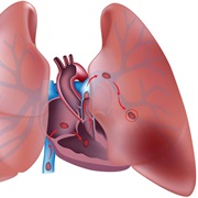Pulmonary Embolism
