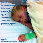 Juvenile Myositis (JM)