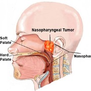 Nasopharyngeal Cancer