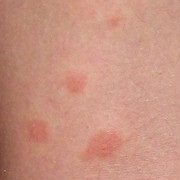 Bug Bites Suck
