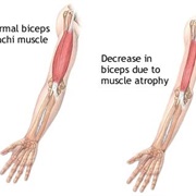 Muscular Dystrophy