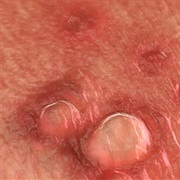 Genital Warts