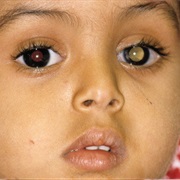 Retinoblastoma
