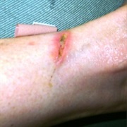 Had an Infected Wound