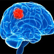 Brain Tumors