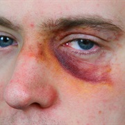 A Black Eye