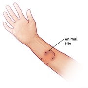 Animal/Human Bite