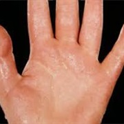 Hyperhidrosis