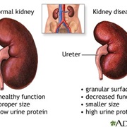 Kidney Disease