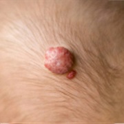 Hemangioma