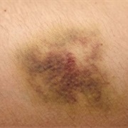 Bruise