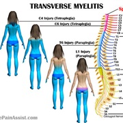 Transverse Myelitis