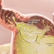 Gastroesophageal Reflux Disease (GERD)