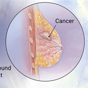 Breast Cancer
