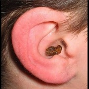 Had Ear Wax Build Up
