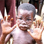 Monkey Pox
